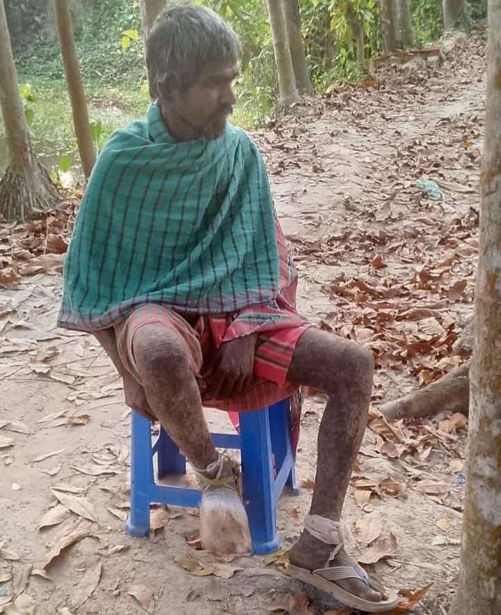 মোল্লাহাটে কুষ্ঠরোগী অমাল রায়ের চিকিৎসায় বাধা দেওয়ার অভিযোগ